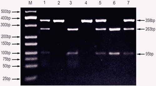 Figure 2 PCR-RFLP assay for analyzing theTLR8-rs3764879 G/C polymorphisms in Sudanese pulmonary  Tuberculosis patients.