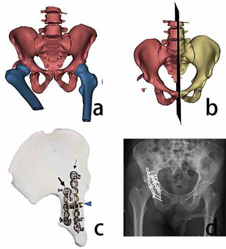 Figure 3. Application of 3D printing technology in the treatment of acetabular fractures (a) 3D image reconstruction of the pelvis and femur of the patient. (b) mirrored reduction of the fractured hemipelvis (c) 3D printed mirror model of the hemipelvis that was used to design pre-contoured plates for internal fixation. (d) follow-up postoperative X-ray [Citation51]