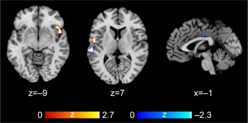 Figure 2 AES-SDM results of the effect of risk allele on gray matter.