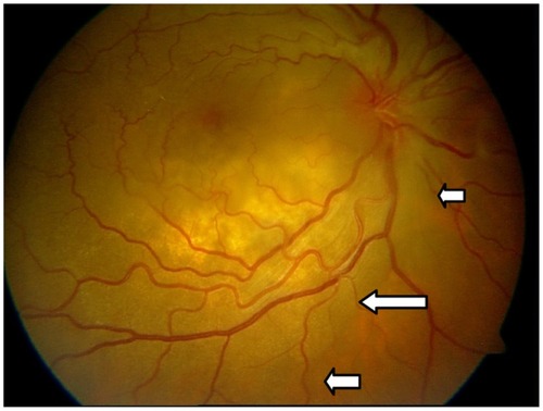 Figure 1 Choroidal granuloma presenting as a subretinal mass with disc involvement in a 45-year-old woman (arrows showing edge of mass).Photograph courtesy of Dhanjay Shukla.