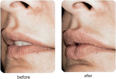 Figure 8 A clinical example of the use of Puragen™ for lip augmentation.