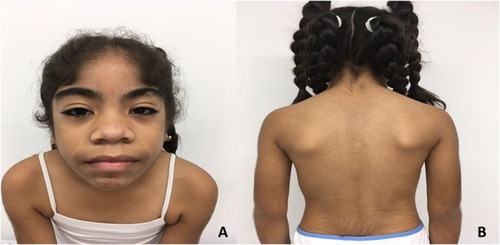 Figure 1 Patient phenotype.Notes: (A) Coarse facial features, AFA, low anterior hairline, synophrys, long eyelashes, epicanthic folds, broad lips, bulbous nose, and broad mouth. Phenotypic similarities with CS. (B) Generalized hypertrichosis predominantly on back and extremities.