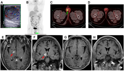 Figure 1 Imaging features of the patient’s lymphoma. (A) Ultrasonography demonstrates a focal area of hypoechogenicity with hypervascularity in the left testis. (B and C) Post-orchiectomy PET/CT shows an FDG-avid lesion (green arrow) in the right testis. (D) PET/CT-based CR was achieved after first-line immunochemotherapy. (E and F) At the first follow-up examination, MRI horizontal and frontal views show a new lesion (red arrow) involving right basal ganglia and pons. (G and H) MRI horizontal and frontal views show that the new lesion disappeared after the first cycle of chemo-free treatment.