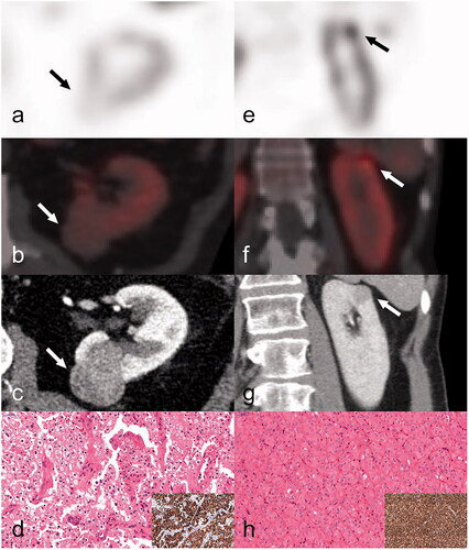Figure 2. A Sestamibi-negative and a Sestamibi-positive chRCC from 2 different patients. First column, a–d: (case 42) SPECT axial image (a) indicates the absence of 99mTc-Sestamibi in a classic chromophobe RCC located to the dorsal aspect of the left kidney (indicated by arrow). Fused axial SPECT/CT image (b), white arrow indicates the tumour. Preoperative axial CT image (c) in the venous phase, white arrow indicates the tumour. The tumour was characterised as a chRCC (d) upon expert review and was diffusely positive for CK7 (inset; d). Second column, e–h: (case 31) SPECT coronal image (e) indicates focal 99mTc-Sestamibi uptake in a chromophobe RCC located to the upper pole of the left kidney (indicated by arrow). Fused axial SPECT/CT image (f), white arrow indicates the tumour. Preoperative axial CT image (g) in the venous phase (white arrow indicates the tumour). The tumour (h) was re-characterised as a LOT upon expert review (LOT: low-grade oncocytic tumour) displaying a CK7 positive immunoprofile (inset; h).