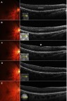 Figure 3 Fundus photographs and OCT B-scan images of the right eye in case 2. The images were obtained at the first examination (5 days after the onset) (A), and at 3 weeks (B), 4 months (C), 1.5 years (D), and 2.5 years (E). (A) Fundus photograph shows a small dark gray lesion just superior to the fovea. OCT shows a hyperreflective band that ranges from the inner plexiform layer to the OPL, and which corresponded to the fundus lesion. (B) Funduscopy shows there was a gradual disappearance of the lesion. OCT revealed that the hyperreflective band was limited to the INL with slight thinning. (C) OCT also showed there was a thin and irregular INL and OPL that no longer exhibited a hyperreflective change, an excavated change of the inner retinal surface (arrow), and thickening of the outer nuclear layer. (D and E) The images remain unchanged.