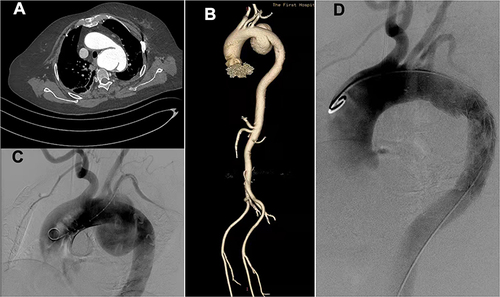 Figure 1 Computed tomography (CT) and computed tomography angiography (CTA) of the patient in pre- and post-operation period. (A). The CT showed rupture of TAA. (B). The Volume reconstruction image showed full picture of TAA. (C). The angiography of pre-operation.(D). The angiography of post-operation.