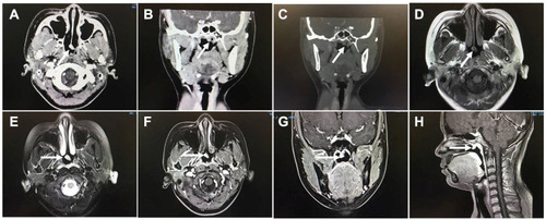 Figure 3 Sinus computer tomography images showed the tumor was pedicled and enhanced at the posterior margin of the nasal septum on the axial images (A, arrow) and the reconstructed coronal images (B, arrow), invading the roof of the nasopharynx slightly. No bone destruction was found (C, arrow). The tumor was demonstrated a moderate signal in T1-weighted magnetic resonance images (D, arrow), and a slightly high signal in T2-weighted magnetic resonance images (E, arrow). It was strongly enhanced in enhanced images (F–H, arrow).