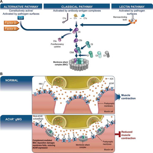 Figure 1. The (A) complement cascade and (B) depiction of the molecular components of a normal vs AChR+ gMG neuromuscular junction and the impact on muscle contraction. Graphics are schematic representations and are not true to scale. In panel A, a truncated version of the full complement cascade is presented with a focus on specific mechanisms relevant to zilucoplan in AChR+ gMG. ACh binds to AChR on normal postsynaptic membrane folds, allowing for normal neuromuscular signaling and muscle contraction. In panel B, autoantibodies against AChR initiate the classical complement cascade, resulting in the deposition of MAC on the postsynaptic membrane, damage to the membrane fold structure, and reduction of AChR expression, resulting in attenuated neuromuscular signaling and muscle contraction. ACh, acetylcholine; AChR, acetylcholine receptor; AChR+, acetylcholine receptor positive; C[x], complement component [x]; gMG, generalized myasthenia gravis; MAC, membrane attack complex; NMJ, neuromuscular junction