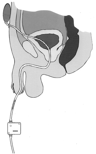 Figure 7. A catheter incorporating some of the concepts in the research agenda. The catheter is retained by wings which spring open after insertion through the suprapubic tract to the bladder: this traps less urine than the balloon of a Foley catheter and the catheter can be withdrawn transurethrally after cutting through it at the external suprapubic port. Multiple drainage eyes in the section of the catheter within the bladder minimize the risk of the formation of pseudopolyps, and this risk is further reduced by a collapsible section (shown stippled) of the catheter situated close to the external meatus of the urethra. The elastic reservoir at the suprapubic end of the catheter and strapped to the abdominal wall expands to accommodate urine from the bladder during spasmodic bladder contraction and returns it to the bladder when it relaxes after the spasm, thus minimizing the possibility of kidney damage. Periodic drainage of the bladder into a leg bag is actuated by a pinch valve beyond the collapsible section of the catheter, under manual or timed automatic control.