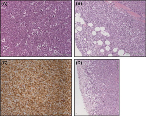 Figure 6. Tumor panels from Z138 tumor-bearing mice showing mantle cell NHL of Z138 human cell line: (A) (× 400 hematoxylin and eosin [H&E]) shows “starry sky” pattern as a result of apoptosis and phagocytosis; (B) (× 100 H&E) highlights infiltrative growth into surrounding subcutaneous tissue (muscle and fat), lacking distinct encapsulation (left; #101), respectively, with formation of a thin tumor-surrounding capsule of tumors of vehicle-treated mice (right, #102); (C) (× 200 CD20) shows strong membrane-bound CD20 expression in almost all MCL cells; (D) (× 100 H&E) demonstrates improved demarcation with increased capsule thickness after treatment with obinutuzumab (GA101) and bendamustine (left, #501) or after treatment with rituximab and bendamustine (right, #602). Note the small rim in the periphery of the tumor with increased vacuolated/degenerative and apoptotic tumor cells.