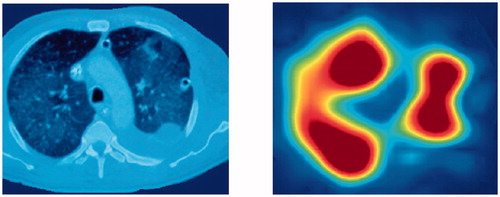 Figure 1. CT scan (left) and functional EIT image (right) from a patient.