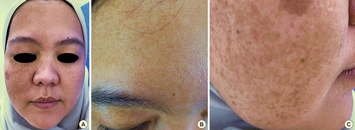 Figure 1 (A) Hyperpigmented macules at the level of the V1 and V2 nerves on the forehead and right cheek. (B) Hyperpigmented macules on the forehead. (C) Hyperpigmented macules on the right cheek.