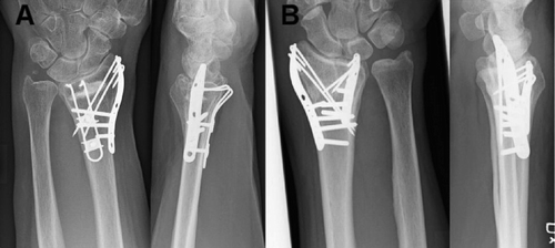 Figure 1. AP and lateral radiographs in two cases of distal radial fracture operated with the TriMed system. A. This patient was operated using a radial pin-plate and a volar buttress pin. Additional stability was achieved using Norian SRS bone substitute. B. In intraarticular fractures with an ulnar fragment, an ulnar pin-plate could be combined with the radial pin-plate.