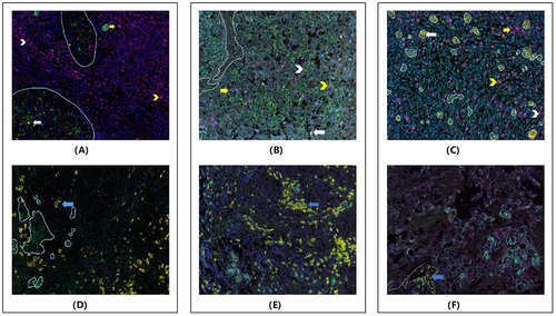 Figure 4 Representative images of different clusters after multiplexed immunofluorescence(mIF) staining in formalin fixed paraffin-embedded tissue sections(FFPE) of triple negative breast cancer of our cohort. (× 200). This information suggests that different subtypes of triple negative breast cancer can be characterized by variations in lymphocyte and macrophage infiltration. In the images, the light turquoise circle in (A, C, D and E) represents the tumor (Except for the tumor, it’s stroma), while the gray circle in (B and F) represents the stroma (Except for the stroma, it’s tumor). The various arrows indicate different cell types: White long arrow: Tumor-associated macrophages 1 (TAM1) - indicated in yellow; Yellow V-shape arrow: CD4+ T cells - indicated in pink; Yellow long arrow: Tumor-associated macrophages 2 (TAM2) - indicated in purple; White V-shape arrow: CD8+ T cells- indicated in red; Blue arrow: B lymphocytes - indicated in yellow. Based on the clusters identified: Cluster 1 (images A and D): T lymphocytes-enriched subtypes. These patients have higher infiltration of T lymphocytes but lower levels of tumor-associated macrophages and B lymphocytes. Cluster 2 (images B and E): B lymphocytes-enriched subtypes. These patients have higher infiltration of B lymphocytes but lower levels of T lymphocytes and tumor-associated macrophages. Cluster 3 (images C and F): Macrophage-enriched subtypes. These patients have higher infiltration of tumor-associated macrophages but lower levels of T lymphocytes and B lymphocytes.
