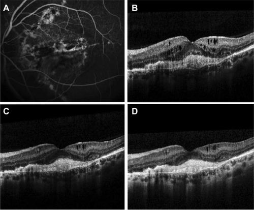 Figure 1 Outcomes at 13 months after ranibizumab treatment (A, B), after 3 loading doses of aflibercept (C) and after 1 year of aflibercept treatment (D). Notes: (A) Thirteen months after treatment with ranibizumab, fluorescein angiography depicts AS around the optic disc and leakage of the dye originating from the CNV, while staining of the fibrotic element of the lesion in the fovea is observed. (B) OCT scan at that point demonstrates subfoveal hyper-reflective tissue associated with CNV and subretinal fibrosis between Bruch’s membrane and the retinal pigment epithelium. Intraretinal fluid and cysts and a subtle accumulation of subretinal fluid are also noted. The CFT is 426 μm. (C) The OCT scan following the 3 loading doses of aflibercept reveals resolution of the subretinal fluid with absorption of the intraretinal fluid and significant reduction of the remaining intraretinal cysts. The CFT is reduced to 348 μm. (D) After 1 year of treatment with 7 IVIs of aflibercept, OCT demonstrates further reduction of the intraretinal cysts while the subretinal fibrosis persists. The CFT is 325 μm.