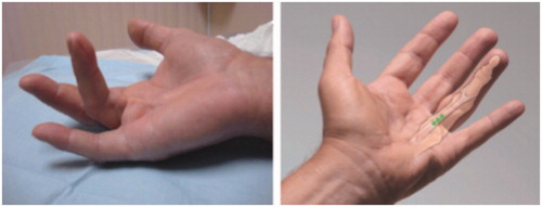 Figure 3. Example of central cord contracture. (left) The structure of a pathologic combined MP/PIP contracture cord is easily visualised and palpated. (right) The surgeon imagines the underlying pathology and plans the placement of the aliquots of a single dose of CCH. Each aliquot is placed centrally in the portion of the cord that is most separated from the underlying flexor sheath. The typical result is full correction of the MP contracture and almost full correction of the PIP contracture. Photos courtesy of LC Hurst.