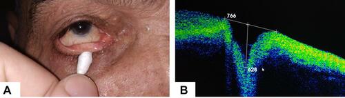 Figure 1 Measuring technique: (A) Lower eyelid margin was everted using a cotton bud into a plane perpendicular to the light source. (B) Anterior segment optical coherence tomography (AS-OCT) image showing punctal parameters (outer punctal diameter (OPD), internal punctum and punctal depth (PD)) of a participant in the control group that was measured using anterior segment module of Topcon 3D OCT-2000 ™ (Topcon Medical Systems Inc.).
