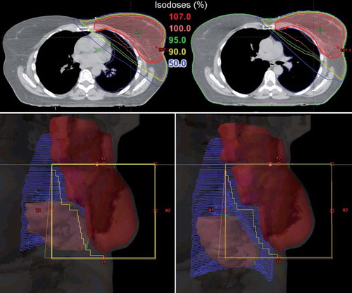 Figure 3. The upper panel shows the dose distribution in a transversal CT slice obtained at the same position of PTV for the same patient during FB (left panel) and DIBH (right panel), respectively. The heart moves out of the high dose region during DIBH. The lower panel shows beam's eye views of the medial tangential field during FB (left) and DIBH (right) for the same patient as upper panel. During inspiration the lung volume (blue) is increased, the breast (red) is moved cranioventrally and the heart (pink) caudally. In the shown case, the heart and the LAD coronary artery (green) was not included in the beam portal (yellow lines) during DIBH. CT, computed tomography; DIBH, deep inspiration breath-hold; FB, free breathing; LAD, left anterior descending; PTV, planning target volume.