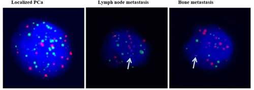 Figure 4. Ezrin expression (blue dots) in CTCs from different stage of PCa by using in situ hybridization.