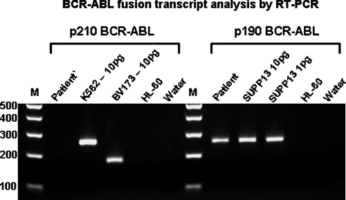 Figure 3.  BCR-ABL fusion transcript expression by RT-PCR. M – 1Kb+ ladder, K562, BV173 and SUPB13 – positive controls, HL-60, water – negative controls.