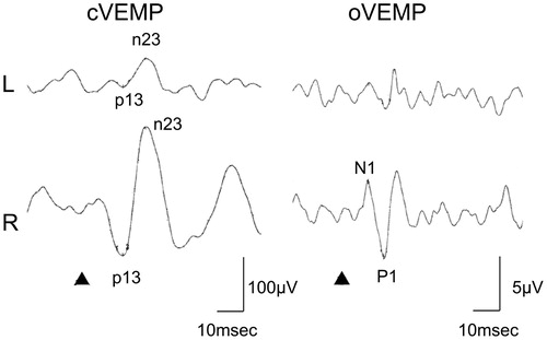 Figure 2. VEMP responses of Patient #2. She showed tendency of decreased amplitudes of cVEMP on the left, however, asymmetry ratio (AR) of corrected amplitudes (=37.4) did not reach the upper limit of the normal range according to our criteria (=41.6 [Citation8]). She showed absence of oVEMP responses to the left ear stimulation. Stimuli were 500 Hz air-conducted short tone bursts (125 dBSPL) ▴: STB presentation.