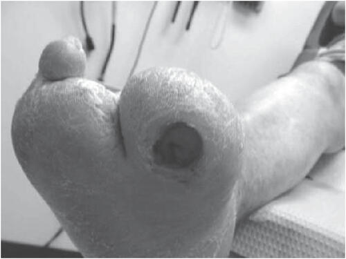 Figure 4 Neuropathic foot ulceration secondary to excessive pressure (from foot deformity) in combination with the repetitive stress from daily ambulation.