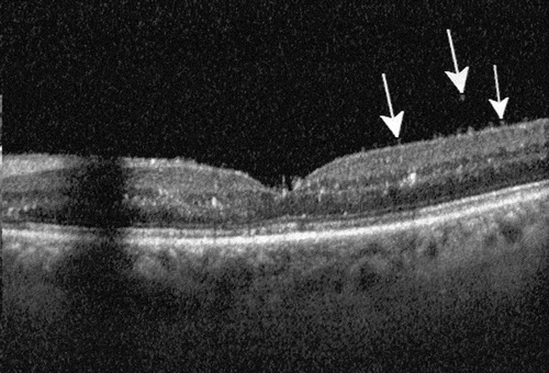Figure 1. Optical coherence tomography of a patient with IOI involving the posterior segment of the eye. Typical changes strongly suggestive of IOI include hyperreflective spots in the pre-retinal vitreous, an irregular inner retinal surface (arrows) and hyperreflective spots in all retinal layers without significant structural damage to the neuroretina as long as the macula is not affected by vascular occlusion. Typically, the anatomic effect of the drug with reduction of retinal fluid is also visible compared to the pre-injection OCT.