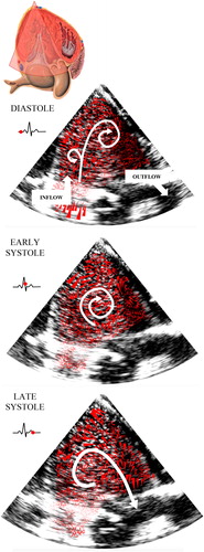 Figure 1. Qualitative representation of velocity fields in case of normal hemodynamics conditions (mean aortic pressure: 100 mmHg, heart rate: 70bpm, mitral flow: 5.5 L/min and E/A ratio: 1.5).