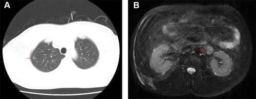 Figure 1 (A) Chest CT detected a 13×4 mm nodule in the right upper lung; (B) abdominal MRI revealed a perirenal tumor, 18×28 mm in size, close to the hilum of the left kidney.