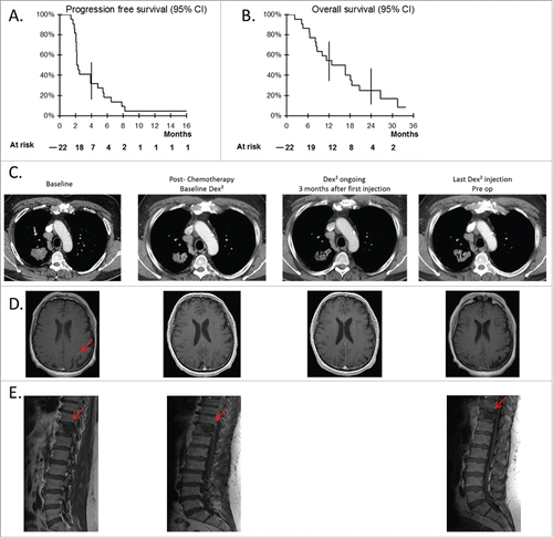Figure 2. Clinical responses to Dex vaccination post-chemotherapy. Progression free survival (A), and OS (B) of the cohort of 22 patients recruited into the trial (95% confidence interval). (C–E) Case report of patient 037. Thoracic (C) and brain (D) CT scans as well as a longitudinal follow up by MRI of the 11th dorsal vertebra (E) are shown for the best clinical response obtained in one patient with a stage IV NSCLC. Imaging at baseline (before-chemotherapy), post-chemotherapy (before commencement of Dex injections), at 3 mo after the first Dex injections, and at the last Dex injection before surgery of the thoracic lesion.