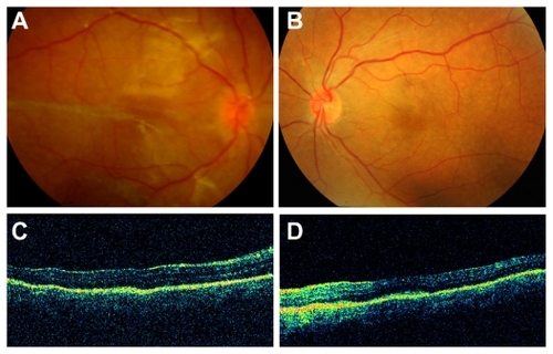 Figure 2 Images obtained after the treatment of sympathetic ophthalmia. Fundus photograph of the right (A) and left eye (B); optical coherence tomography images of the right (C) and left eye (D) fundi.