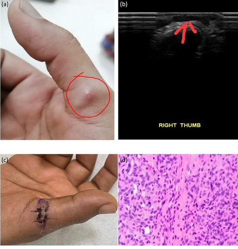 Figure 1 (a) Preoperative clinical pictures showing a soft nodule suggestive of glomus tumor. (b) Ultrasound images showing a raised size of 1.3×0.7 x 0.5 cm on the base of right thumb. (c) Postoperative image showing direct complete excision approach. (d) Histopathological images showing round to ovoid glomus cells with interspersed fibroblast, delicate vasculature and myxoid stroma. No evidence of necrosis, mycosis and atypia was seen.