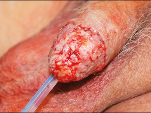 Figure 3 Completed glansectomy with split-skin graft.