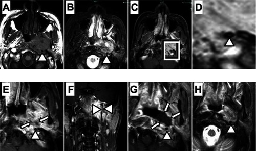Figure 1 (A–D) MRI study of the left-sided nasopharyngeal carcinoma before combined CRT plus cetuximab therapy, showing extensive involvement of the left prevertebral and the pterygoid muscles with encasement of the left ICA (A: axial T1WI, B: T2WI with fat suppression, C: Gd+T1WI; D: magnification of the lesion in C). (E and F) One month after treatment (E: Gd+T1WI shows patchy unenhanced areas in the center of the lesion, representing foci of necrosis; F: coronal Gd+T1WI shows the ICA meandering through the lesion). (G and H) Three months after treatment (G: Gd+T1WI shows large unenhanced area, bordering the ICA, in the lesion; H: T2WI shows the unenhanced area to be of moderately high signal intensity, representing coagulative necrosis of the lesion)