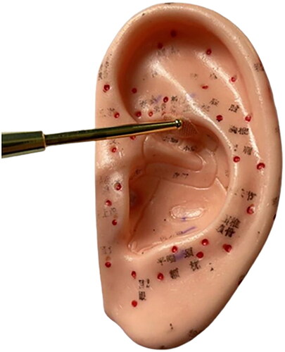 Figure 3. Auricular acupressure.Auricular acupressure corresponding to the point of the liver at the ear is located in the middle of the outside of the ear fossa, close to the helix.