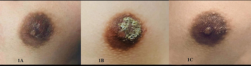 Figure 1 The skin lesions before and after the abrocitinib therapy. (A) The skin lesion on the right nipple and areola before the abrocitinib therapy. (B) A week later after the abrocitinib therapy. (C) Two weeks later after the abrocitinib therapy.