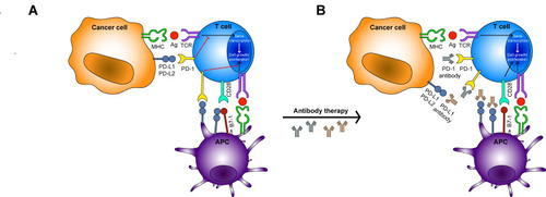 Figure 2 Mechanism of anti-tumor immune surveillance and PD-1/PD-L1 inhibitors. (A) Shows that PD-L1 is highly expressed in tumor cells and tumor-related APCs, while PD-1 is highly expressed in tumor-infiltrating lymphocytes. The combination of PD-L1 and PD-1 can inhibit the activation, proliferation and anti-tumor function of CD8+ T cells and realize tumor immune escape. (B) Shows that after antibody treatment, anti-PD-1 will bind to PD-1, preventing PD-1 from binding to PD-L1 or PD-L2, and anti-PD-L1 will bind to PD-L1, blocking the binding of PD-L1 to PD-1 and B7-1, releasing the tumor-specific killing ability of T cells.