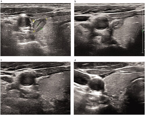 Figure 5. Size of the ablation area at (a) 1, (b) 3, (c) 6, and (d) 12 months after MWA. Well-treated tumors exhibiting changes to a hypoechoic nature, marked decrease in size, and loss of internal vascularity on Doppler US. The volume of the nodule is measured from 0.158 cm3 immediately after MWA to completely disappear at 12 months, and the volume reduction rate (VRR) is 100%.