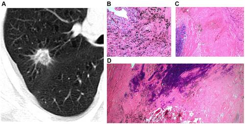 Figure 3 Solid SPIN with heterogeneous density (type III) and spiculations (A) on lung window. Pathologically, it consists of multiple components including fibrous tissue (B), hyaline change (C), calcification (D), and few inflammatory cells (B and C).