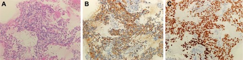 Figure 1 Hematoxylin–eosin staining and immunohistochemistry in adenocarcinoma before crizotinib treatment.