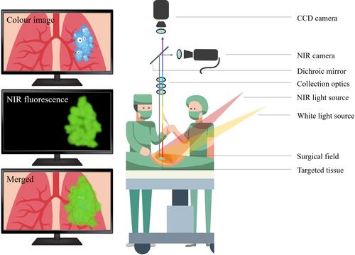 Figure 1 Schematic representation of the surgical field and NIR fluorescence imaging system able to capture in real-time two imaging channels simultaneously.