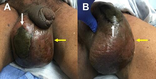 Figure 1 Physical examination findings of Fournier Gangrene. Note a large area of necrosis (white arrow) as well as soft tissue edema and erythema (yellow arrow).