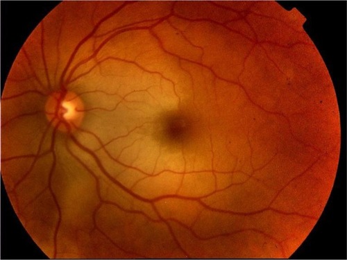 Figure 1 Color fundus image of the left eye showed an area of retina whitening, extending along the distribution of three cilioretinal arteries.