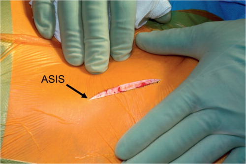 Figure 3. With the minimally invasive approach, the skin incision begins at the anterior superior iliac spine and continues distally for approximately 7 cm along the sartorius muscle. The arrow points to the anterior superior iliac spine (ASIS).