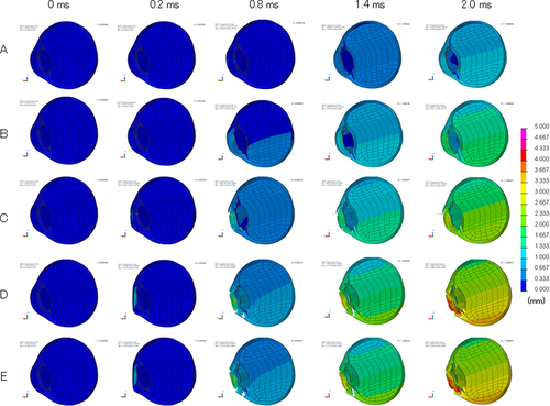 Figure 3 Sequential deformity of emmetropic eye upon airbag impact at five different velocities. Cases of impact velocities of 20 (A), 30 (B), 40 (C), 50 (D), and 60 m/s (E) in the normal-length model eye are shown. Results at 0, 0.2, 0.8, 1.4 and 2.0 ms after the impact are displayed. Axial deviation from the baseline position is displayed in each figure on a color-bar scale.