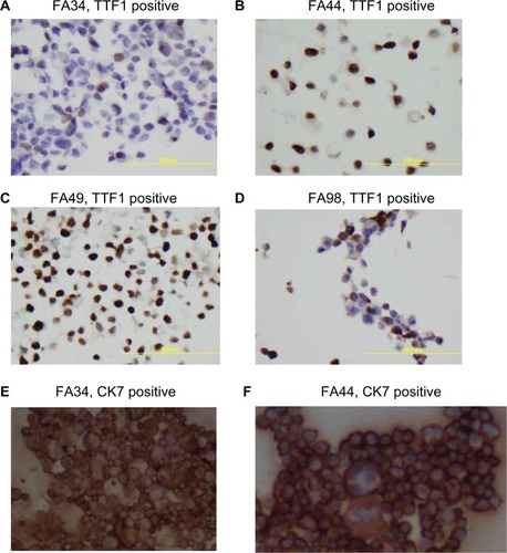 Figure 2 Immunohistochemical staining with TTF1, CK7, and CK20 on paraffin cell blocks for all four lung adenocarcinoma cell lines.