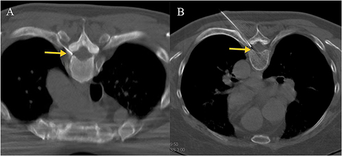 Figure 1 The yellow arrow points to the needle placed in the intervertebral foramen. (A). T3 spinal nerve; (B).T6 spinal nerve.