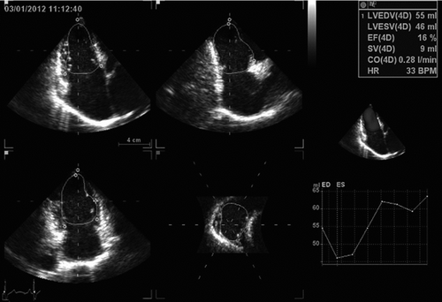Figure 2.  The measurement of right ventricular volumes and function using single-beat real time three-dimensional echocardiographic semi automatic images processing software (4D Auto LVQ). Volume time-plot and quantitative analysis and three-dimensional model are presented in the right panel.