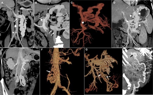 Figure 1 Coronal-oblique MIP CT images and VR CT images of portosystemic shunts.