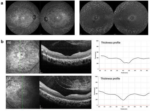 Figure 2. Clinical phenotype of patient with compound heterozygous for single nucleotide variants in CRB1. (a) Infrared (left) and autofluorescence (right) imaging shows atrophic changes in the central retina with hyperfluorescent spots outside the temporal arcades. (b) Characteristic for a CRB1-associated RP, both left and right eye show increased retinal thickness. the retinal lamination pattern is coarse, reminiscent of an immature retina and disrupted by intraretinal exudates.